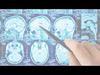 Good Brain, Bad Brain: Parkinson's Disease